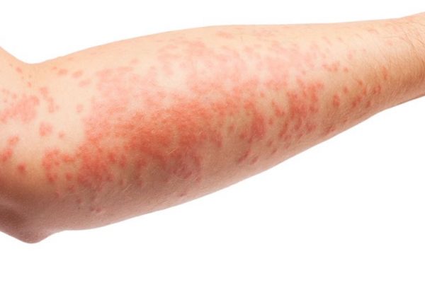 Eczema and Inflammatory Skin Condition
